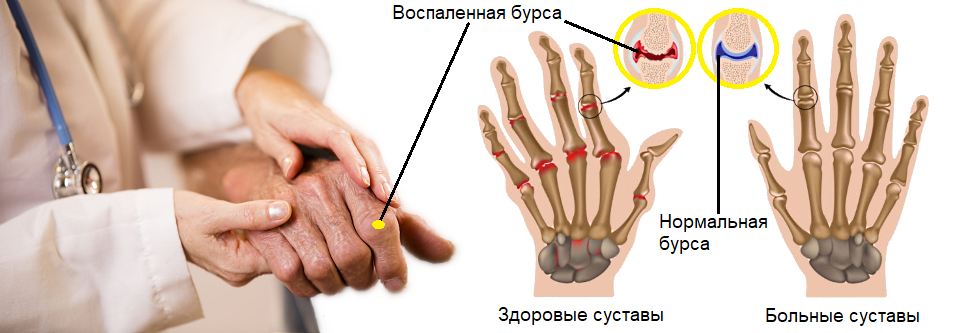 Подвижность суставов пальцев. Воспаление сустава большого пальца руки. Воспаленные суставы на пальцах рук. Воспалился сустав на пальце.