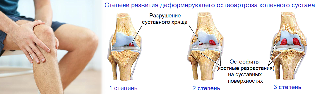 Можно греть артроз коленного. Деформирующий остеоартроз 2 степени. Поражение суставов при деформирующем остеоартрозе. Стадии доа коленных суставов. Артрит голеностопного и коленного суставов.