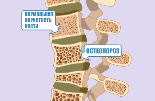 Питание при остеопорозе