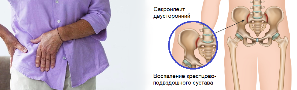 Сакроилеит что это симптомы лечение. Радиочастотная денервация нерва. Сакроилиит или сакроилеит. Сакроилеит что это симптомы лечение. Болезнь бехтерева мрт кпс.