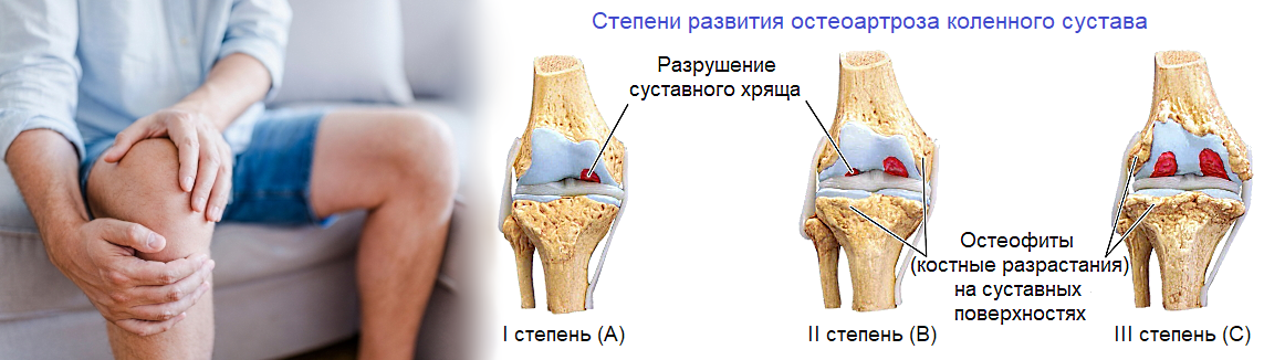 Хрящ коленного сустава артроз. Остеоартроз (деформирующий остеоартроз). Деформирующий остеоартроз клинические проявления.