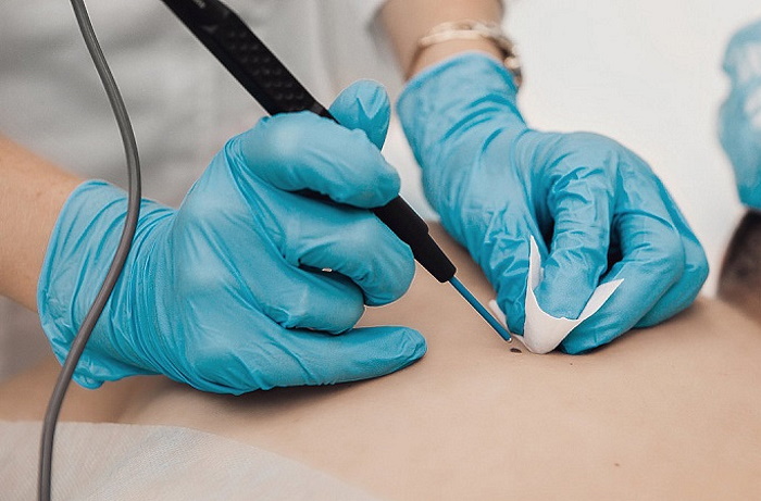 «Сургитрон» — хирургия без боли в клинике на Чертановской