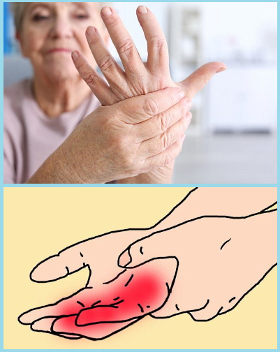 Воспаление сухожилия кисти руки