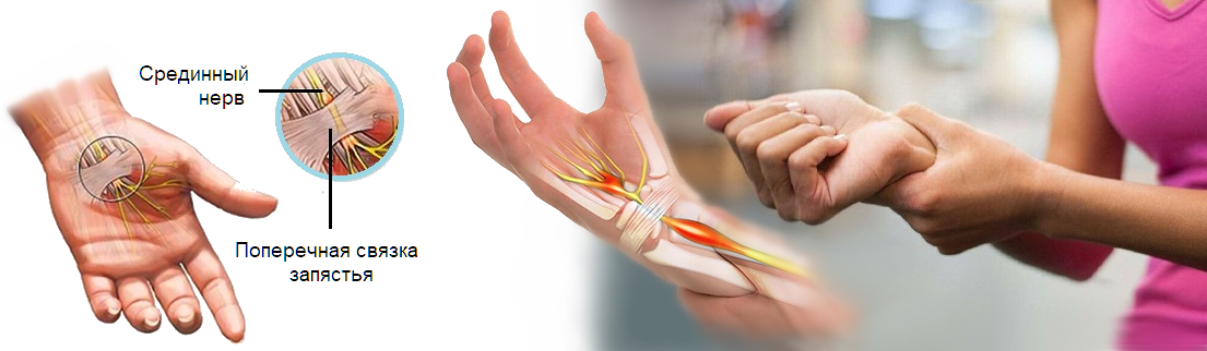 Лечение артрита пальцев рук народными средствами