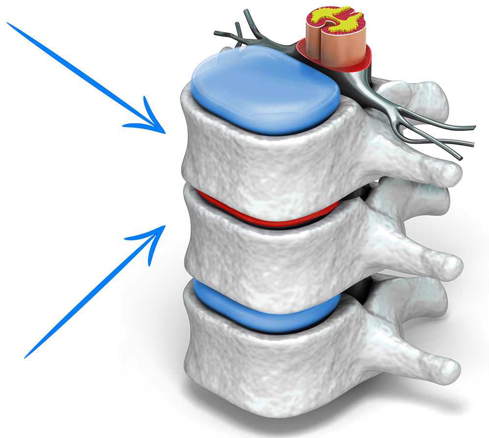 Деформация межпозвонковых дисков