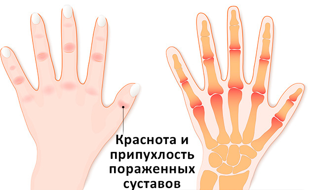 Симптомы при артрите пальцев рук