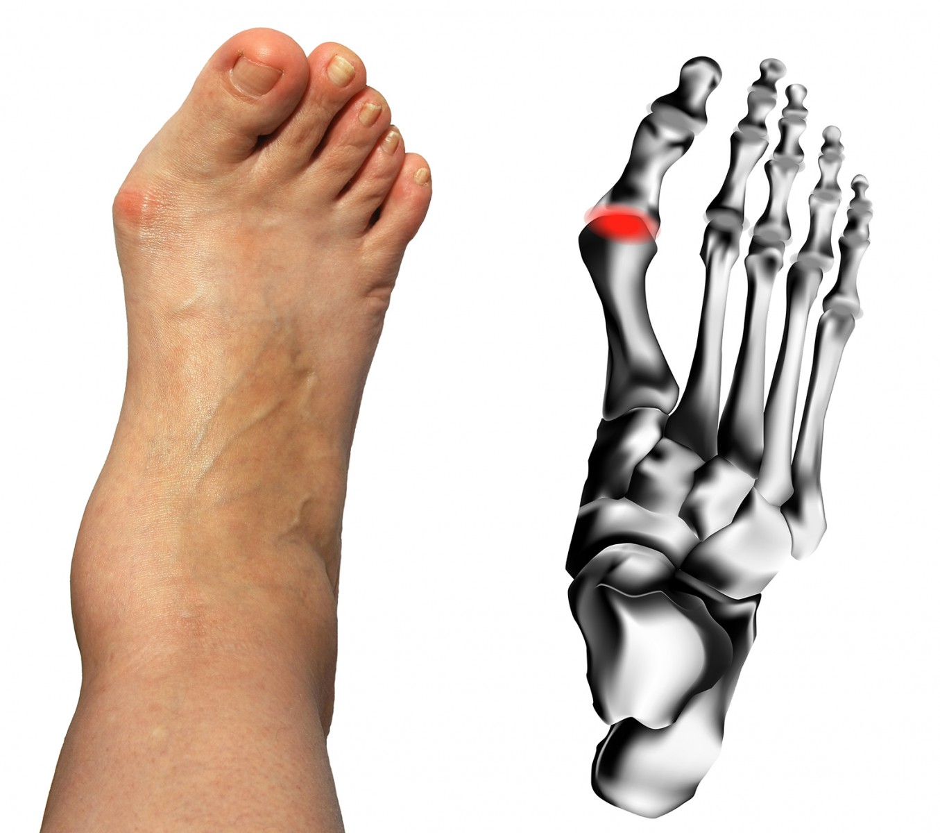 Причины артроза пальцев ног