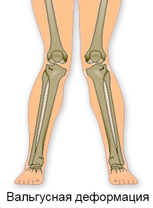 Вальгусная деформация: колени