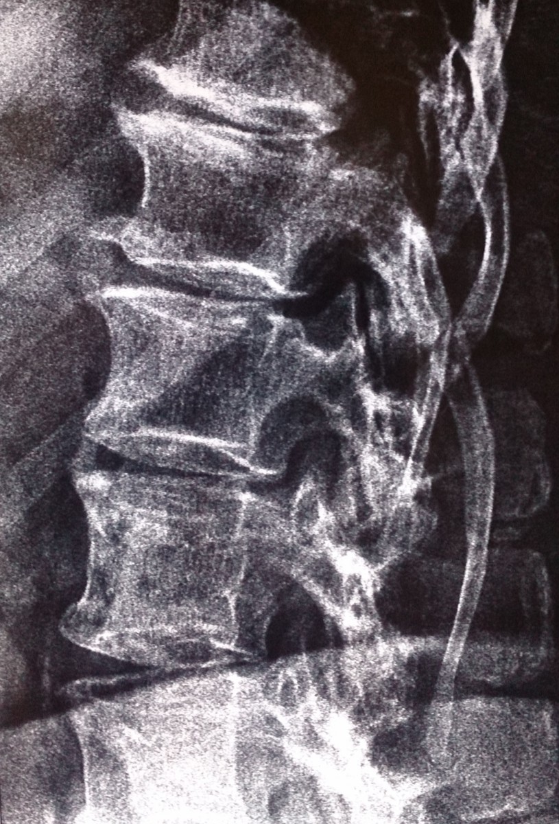 Рентген при защемлении нервов