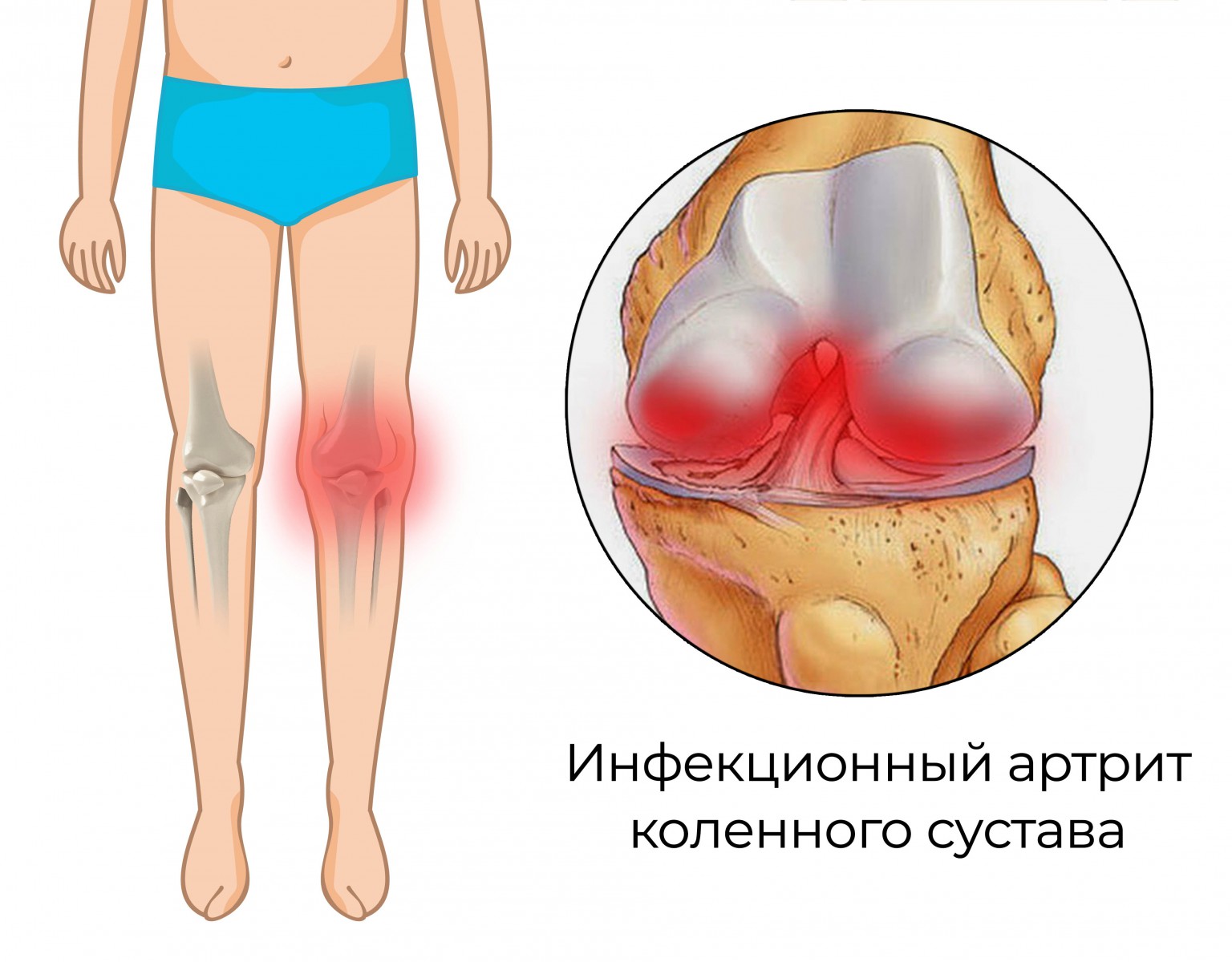 Артрит коленного сустава инфекционный