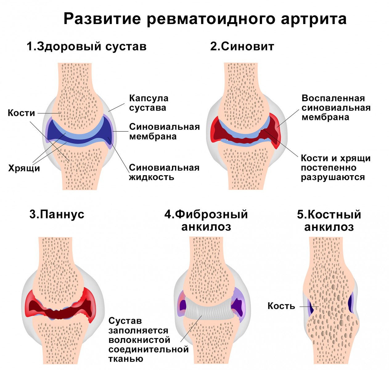 Ревматическое поражение суставов. Ревматоидный артрит алгоритм лечения схема. Ревматизм и ревматоидный артрит. Основные причины ревматоидного артрита. Клинические проявления ревматического артрита.