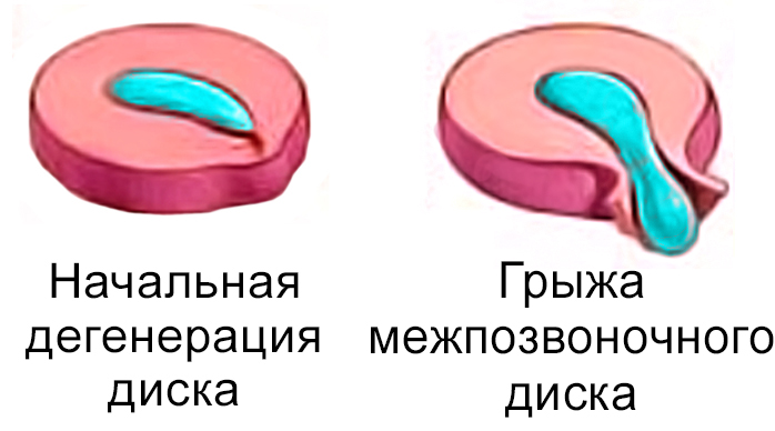 Лечение грыжи позвоночника