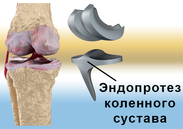 Имплант коленного сустава фото