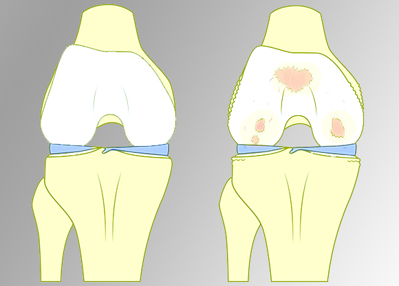 Артроз на примере коленного сустава