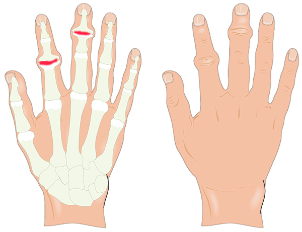 Распространенные болезни пальцев на руках