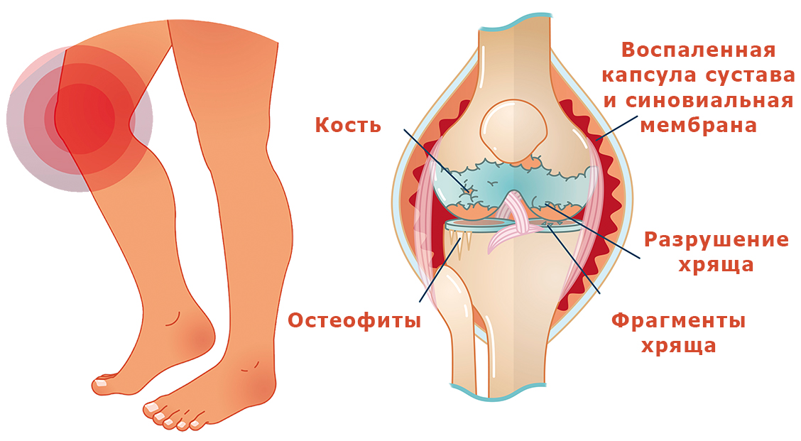 gonartroza koljena antiinflamatoare cu artroza genunchiului