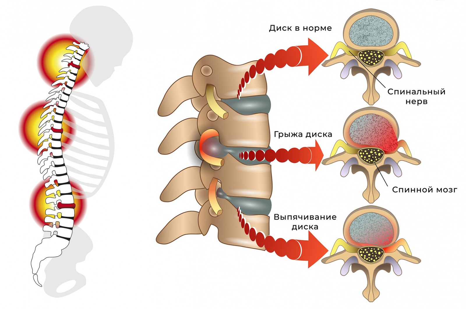 Грыжа позвоночника картинки