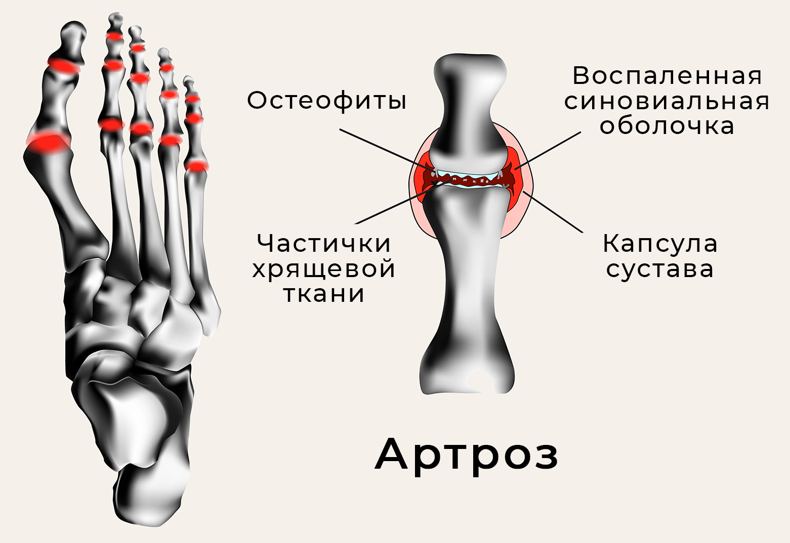 Ревматоидный артрит ног: лечение и симптомы