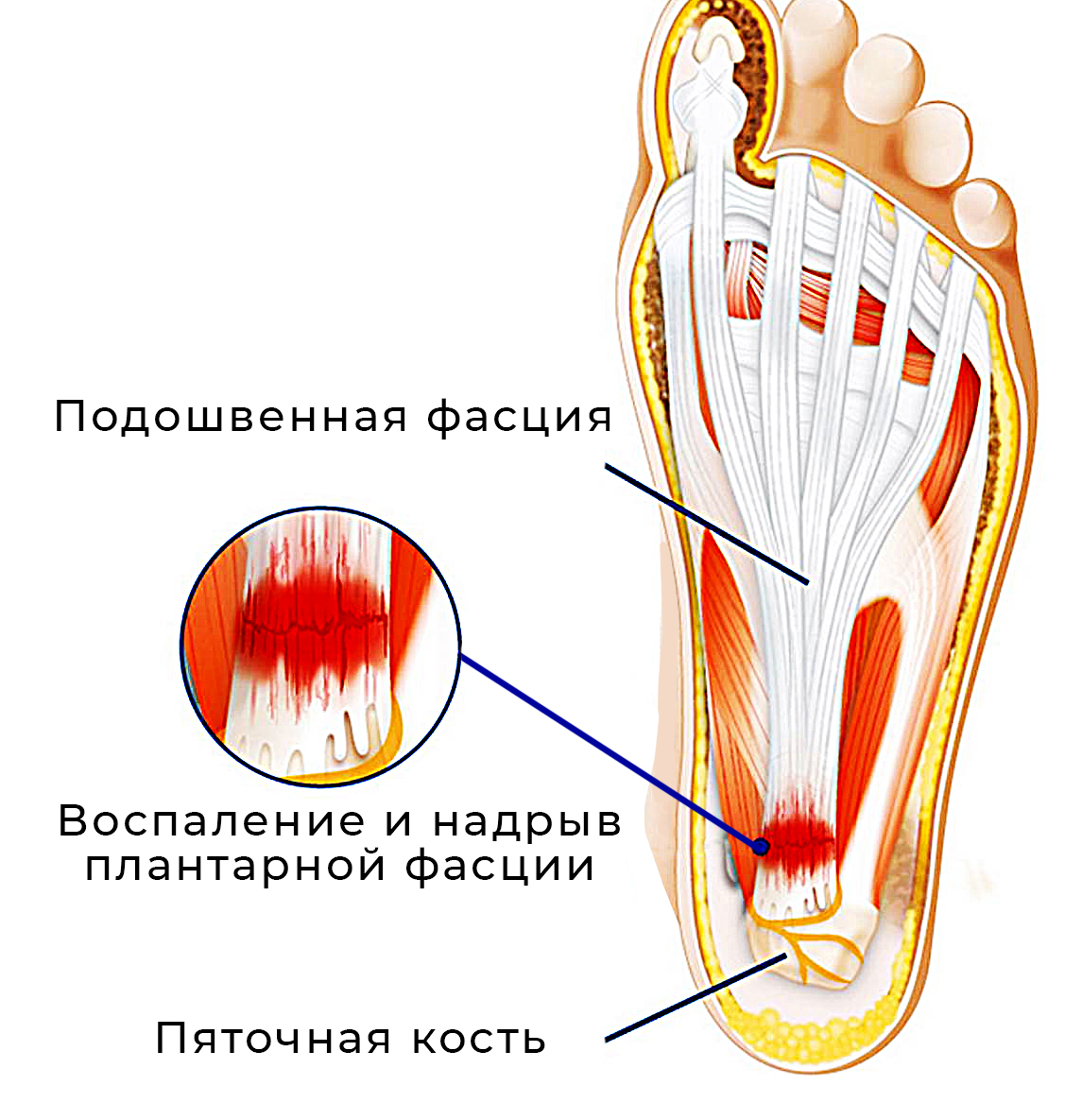 Причины боли внутренней стороны стопы. Боль сбоку пятки с внутренней стороны. Болит внутренняя часть пятки сбоку.