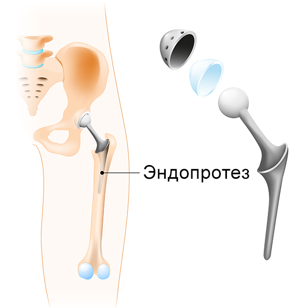 Тазобедренные суставы производители. Эндопротез тазобедренного сустава операция. Эндопротезирование левого тазобедренного сустава. Компоненты тотального эндопротеза тазобедренного сустава. Эндопротезирование ТБС операция.